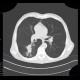 Lung carcinoma, biopsy: CT - Computed tomography